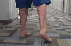 gait walk disorders patient when gif