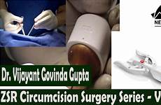 circumcision cosmetic zsr video