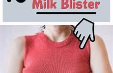 blister breastfeeding pumping remedies blisters blebs