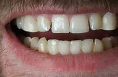 teeth fangs vampire fx special gif scary retractable