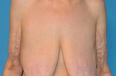 saggy reduction breast