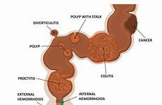 hemorrhoid stool anus bleeding rectal causes hemorrhoids polyp fissure colitis proctitis diverticulitis
