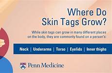skin tags causes grow neck under inner thighs skinny answers questions arms