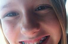 braces girl real smile make cheeky photography life orthodontist thats minutes left after