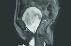 uterine prolapse rectal operative concomitant