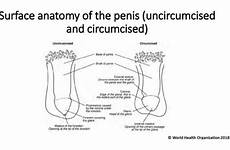 circumcision anaesthesia