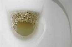 urine foamy kidney kencing berbuih blackdoctor foam symptom symptoms kidneys schaum adakah bahaya puncanya mengatasinya