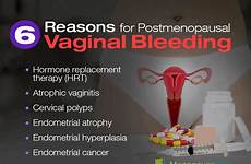 bleeding menopause postmenopausal during causes vaginal lining post perimenopause does uterine symptoms after women why menopausal abnormal common reasons polyps