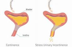 incontinence coital urinary sexual urine vibrance ejaculation leaking intercourse upon