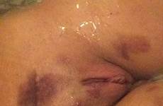 bruised tumblr boobs