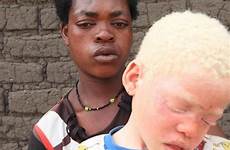 albinos armen afrika welle morden ihrer gerissen cedrick verlor edna neunjährige einfach jährige soll gestoppt afrikanischen verschleppt