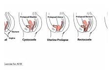 prolapse uterine recti diastasis pelvic exercises floor