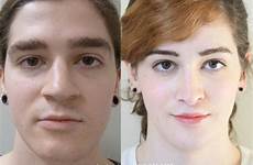 surgery facial feminization transgender after before male female ffs mtf face gender feminisation feminine women illinois surgical makeup jenner caitlyn