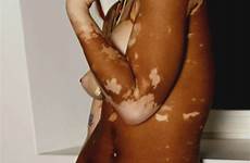 vitiligo unique sexy pussy girls tits shesfreaky ebony auriga hairy suicide photography fuck group