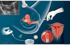 insemination intrauterine iui treatment fertility artificial pregnancy women ivf injection fertilization sperm expert sections bloglovin article