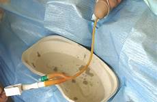 catheter urethral male catheterisation play felt resistance gently pull until bladder foreskin wash opening