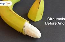 circumcision after before penis uncircumcised skin hood head foreskin procedure removed