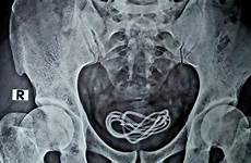 penis charger urethra bladder cnn ray puts kandung kabel kemih rectum ditemukan pria kok bisa cellphone xray