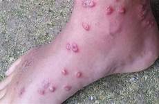 itch skin parasite swimmer swimmers burrows into bumps causes signs usatoday