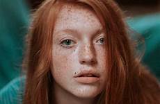 freckles redheads redhead braces