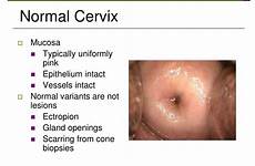 normal cervix clinical considerations ectropion lesions findings mucosa biopsies scarring cone openings gland ectopy