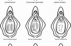 hymen configurations determining myths couldn dispelling