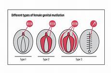 fgm procedure terrifying