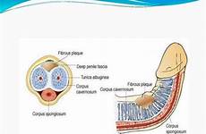 peyronies peyronie curvature symptoms pathophysiology implant