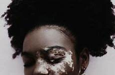 vitiligo start