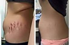 cicatrice scars vergetures stretchmarks strech enlever xp burn cicatrices itworks strechmark elasticity stretc stretching rouges musculation