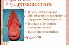 uterine prolapse ulcer obstetrics topic science kb