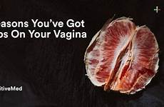 vagina bumps got sweat gland infected positivemed
