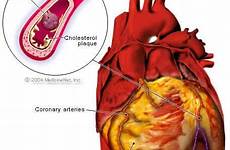 attack heart infarction symptoms early myocardial illustration warning signs