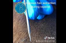 pubic hair ingrown mound extraction