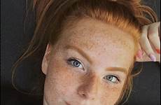 freckles redheads