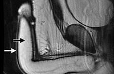 mr penis penile anatomy scrotum normal coronal imaging sagittal corpora 1a figure white arrow albuginea tunica spongiosum radiographics t2 corpus