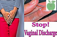 vaginal discharge itching vulva irritation causes