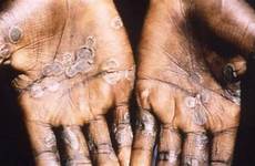 monkeypox virus africa nigeria case mild patient had after cdc typically occurs considered remote health parts central west contracts worker
