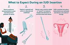 iud insertion mirena expect spirale verywellhealth intrauterino inserted uterus ginecologo infection contraception cliomakeup impianto pelvic verywell exam