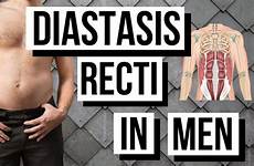 diastasis recti bulge men belly fix over