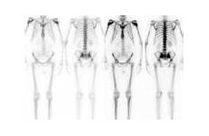 superscan nuclear prostate bone metastatic radiopaedia lc radiology