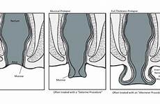 prolapse rectal illust northwest 1456 16t15