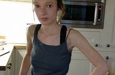 diet anorexic weight pills anorexia pill nearly amber girling after her 4st became stone called zoe rachel killed says disease