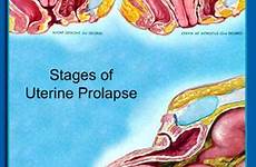 prolapse pelvic uterine organ floor causes vaginal stages birth degrees cause much child