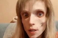 anorexic anorexia loss helped kristina weighs corpse thanked says