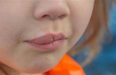 lips lip swollen burn degree causes