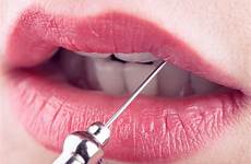 labbra concetto medische vrouwelijke lippen naald esthetisch botox graziose bacio ragazza vesta vostre rosso colpo dentist plastica femminili medico