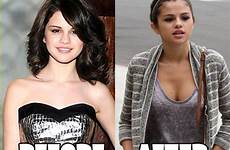 selena surgery plastic gomez before after breast implants enhanced lips injections her surgeons some celebrity when confidently said assets other