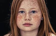 freckles rousseur taches