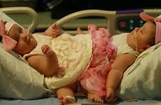twins conjoined texas twin girls surgery separated old month torres hernandez set ximena scarlett separation separate
